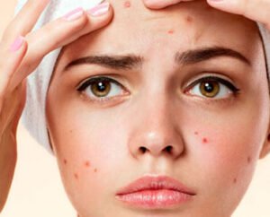 Acne Treatment