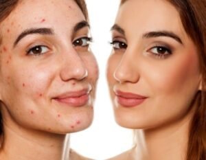 Acne Treatment
