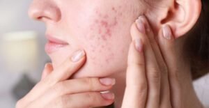 Acne Treatment