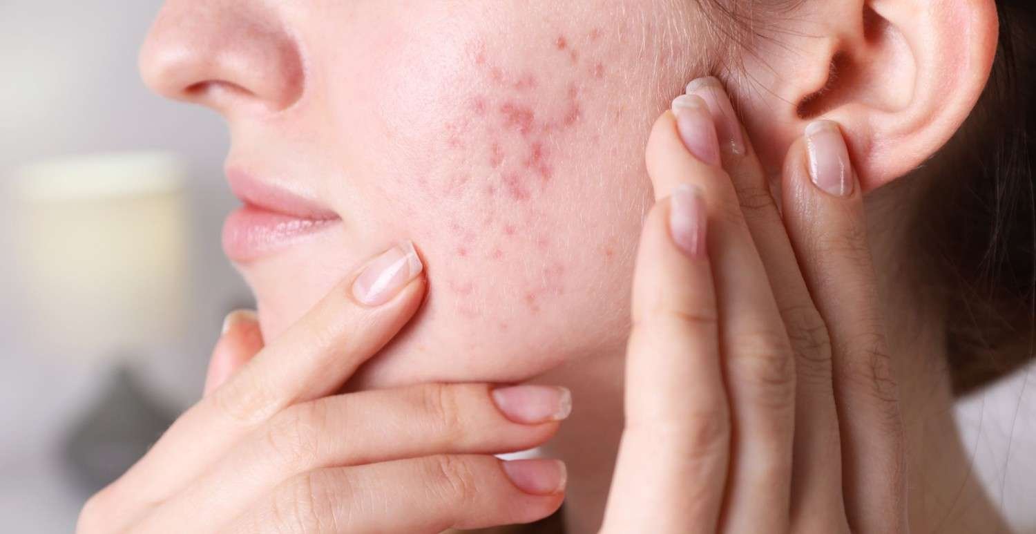 Acne Treatment