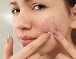 Acne Treatment