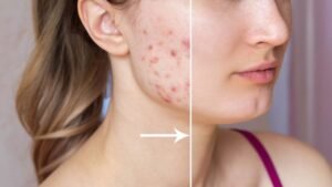Acne Treatment