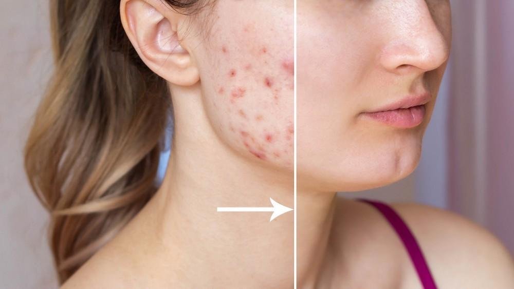 Acne Treatment