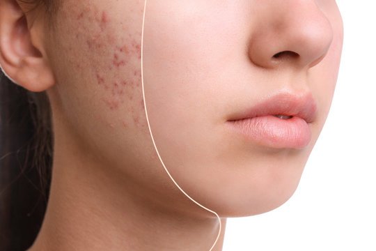 Acne